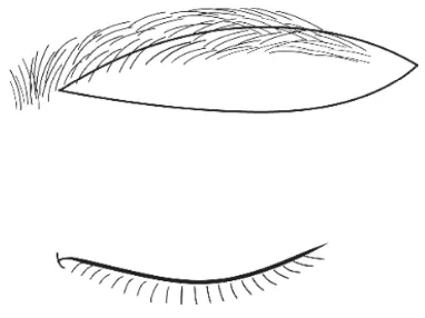 Figure 1 Design of extended IBEB. The medial end of the excised skin pad is 5 mm laterally in from the start of the eyebrow, and the lateral end of the skin pad is 5–10 mm laterally out from the tail of the eyebrow