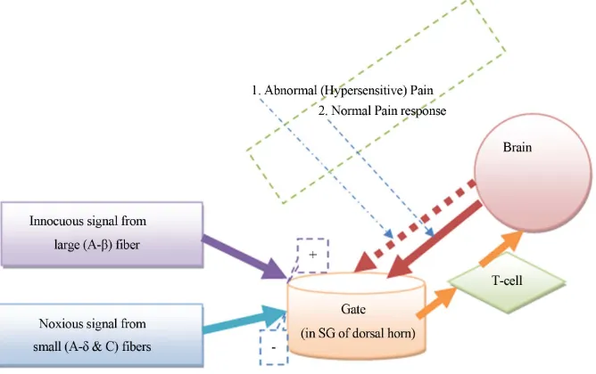 Figure 1. Gate control theory, [8]: Components and basic link of gate mechanism with normal and abnormal (hypersensitive) pain response