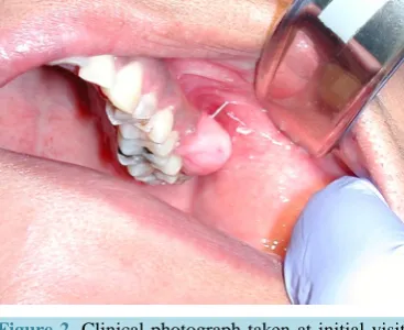 Figure 1. Panoramic radiograph taken at initial visit demonstrating severe caries on tooth #15 (arrow)