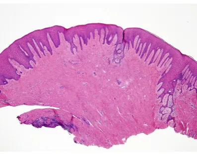 Figure 4. H&E stained biopsy specimen at 40× power representing a mucosal nodule covered by intact kera-tinizing squamous epithelium