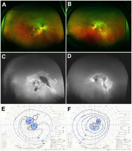 Figure 2 Case 2: (perimetry.Abbreviation: A and B) Optomap color fundus imaging (A) and wide-field FAF (B) of the right eye