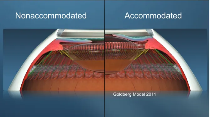 Figure 3 schematic diagram showing half eye in accommodation and half eye in disaccommodation
