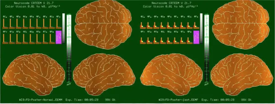 Figure 1. Comparison of frequency analysis performed by conventional 4 s lasting epochs (left side) and new 364 ms lasting epochs (right side)