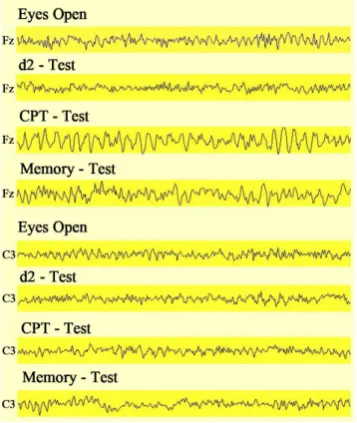 Figure 2. Comparison of new fast dynamic analysis (epochs of 364 ms dura-tion) with classical analysis (4 s duration) with respect to transitions from one frequency range to the next one