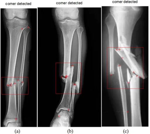 Figure 8. Result of Harris Corner Detection (a) Bone with Seven Corner Points, (b) Bone with eight corner points, and (c) Bone with Nine Corner Points