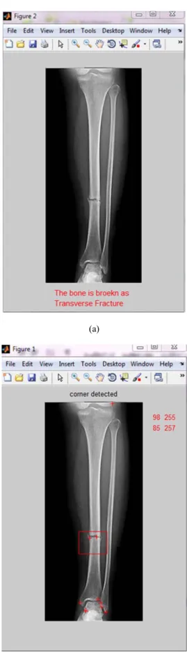 Figure 11. Result for Normal Bone. 