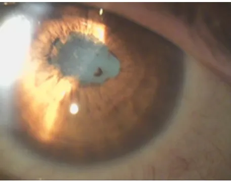 Figure 5 recurrent nongranulomatous iridocyclitis with posterior synechiae in the left eye of a patient working in a furs elaboration industry, with positive serology for B