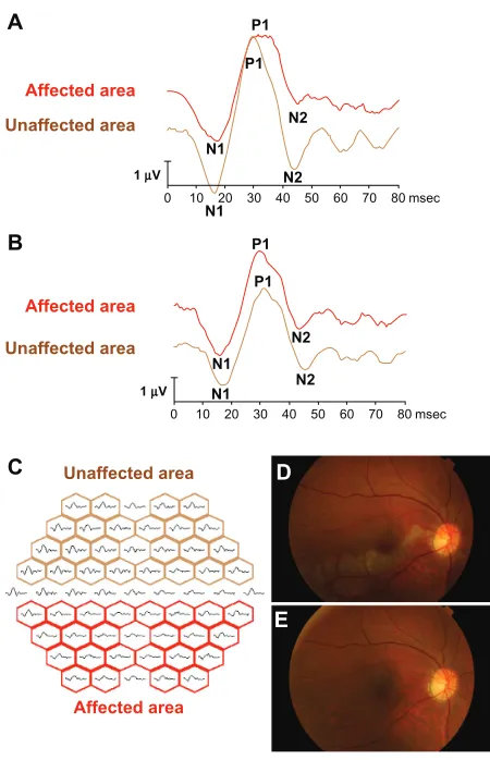Figure 1 The representative mferGs before and after Tes and mferGs are divided each area and calculated the ratio of affected area and unaffected area