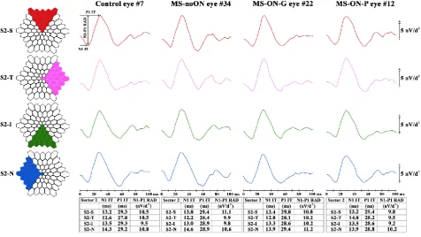 Figure 3. Multifocal electroretinogram averaged recordings obtained in a Control eye (#7), in a patient with multiple sclerosis (MS) without history of optic neuritis (MS-noON#34), and with history of optic neuritis followed by good or poor visual acuity (