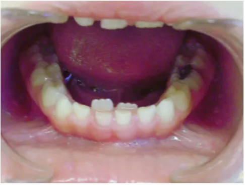 Figure 8. Frontal-intraoral view showing Spacing between teeth.   