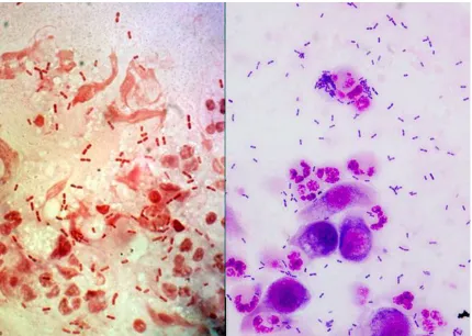 Figure 1. The presence of Moraxella diplobacilli from corneal scrapings using Gram stain 