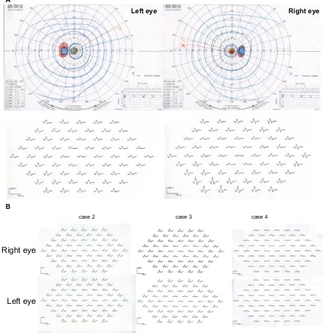 Figure 3 A) goldman perimetry and multifocal electroretinogram (erg) of case 1. B) Multifocal erg of cases 2, 3, and 4