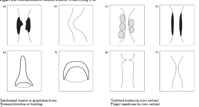 Figure 2.4. Classification of tracheal stenosis. From Freitag et al82. 
