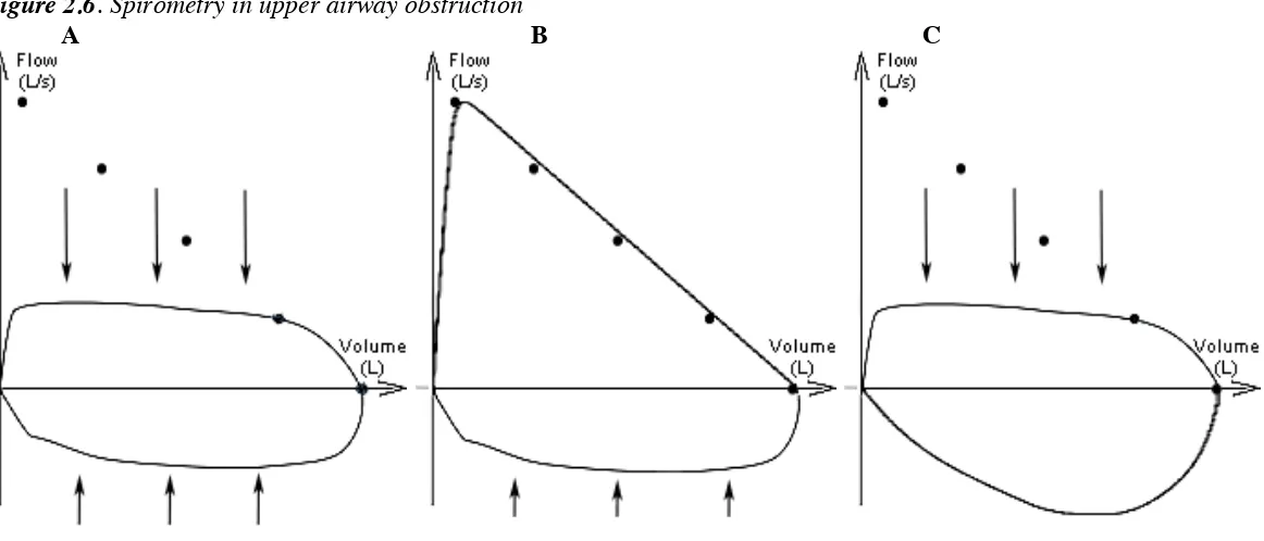 Figure 2.6. Spirometry in upper airway obstruction 
