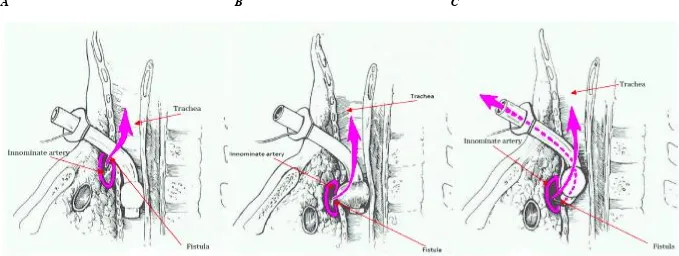 Figure 2.8. Mechanisms of tracheo-innominate fistula formation 