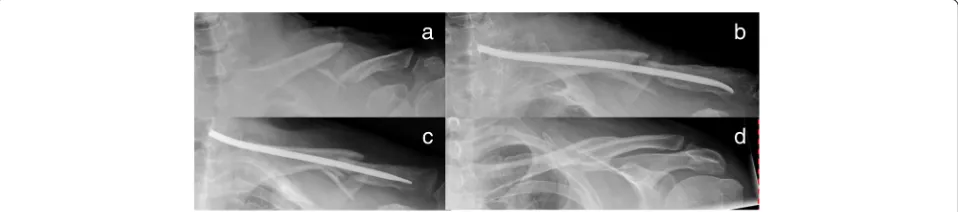 Fig. 7 Robinson 2B2 fracture (a) treated with TEN (b); telescoping effect after 6 weeks at the medial side (c), after consolidation and implantremoval (d)