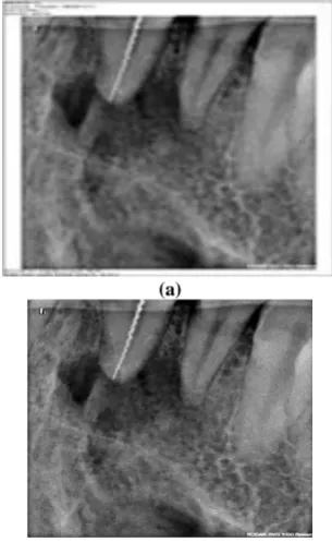Fig 1: Dental X-Ray image (a)Original Image (b) The (b) border noise removed image 