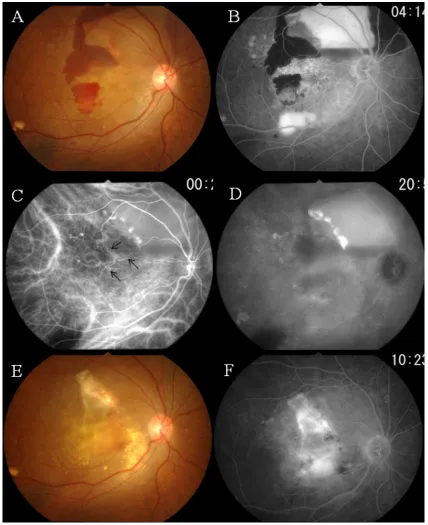 Figure 2 Case 1. Three years and five months after the initial photodynamic therapy (PDT).applied to the polypoidal lesions and PDT combined with an intravitreal injection of bevacizumab: the exudative changes have subsided, leaving a subretinal fibrovascu