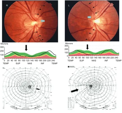 Table 2 Difference in the ophthalmic features of NOH and glaucoma with NOH-like visual field defects