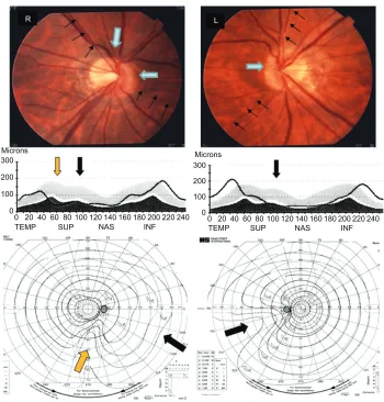 Figure 2 Clinical manifestations of a bilateral NOH case with SSOH (Patient 4).nasal and superior sectors of the peripapillary retina (indicated by black arrows) were observed in the fundus photographs