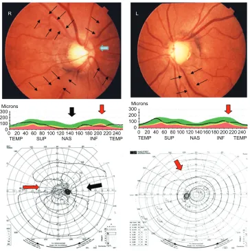 Figure 3 Clinical manifestations of a unilateral NOH case with NTG (Patient 6).Top: Bilateral glaucomatous large disc cupping, double-ring appearance of nasal sector of the optic discs (OD, indicated by a blue arrow) and the presence of NFLD in the superot