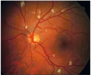 Figure 1 Numerous cotton wool spots typical of Hiv retinopathy.