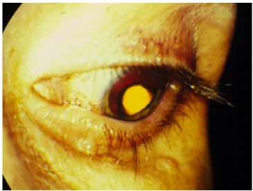 Figure 4 Sustained-release ganciclovir implant sutured to the pars plana as seen through the pupil.