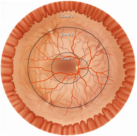 Figure 5 Diagram of the retina shows the three anatomic zones used for classification of CMV retinitis.