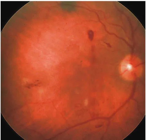 Figure 4 Retinal hemorrhage and leak into the vitreous from a single laser spot in the superior aspect of the retina where grid laser was performed.