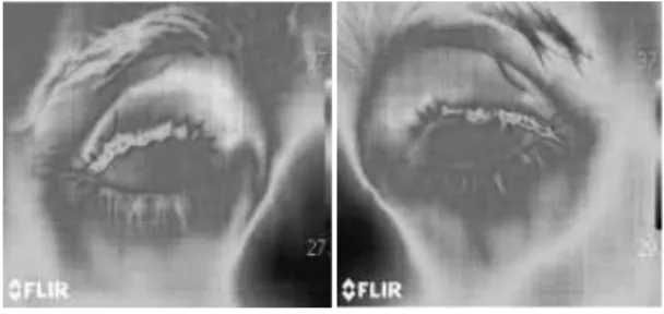 Figure 6. Sample thermal images: (a) and (b) normal eyes, (c) and (d) diseased eyes.                         (a)                                            (b)                                   (c)                                         (d)SensitivitySpec
