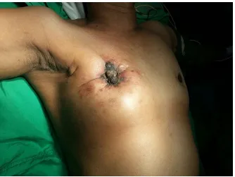 Figure 1. Pre-operative photograph showing a grossly scarred right breast.               