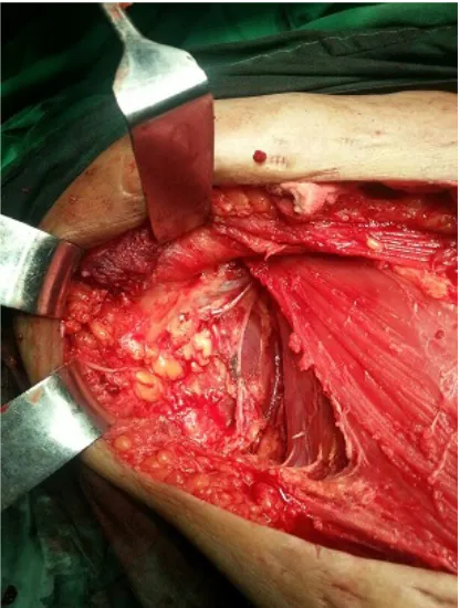Figure 2. Intraoperative photograph showing exposure of the ribs after removal of amajor portion of the pec- toralis major muscle