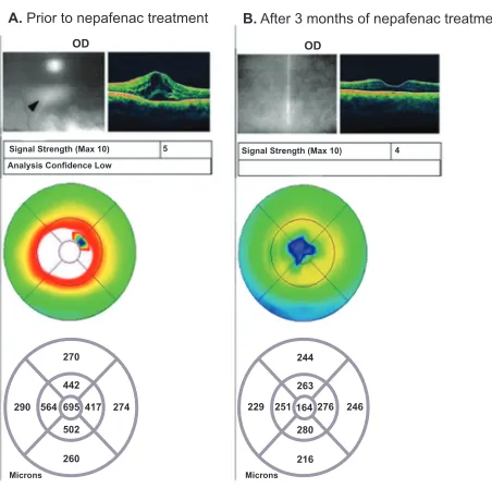 Figure 1 Recalcitrant uveitic CME: Patient #1 OCT images. retinal edema and cystoid spaces (see arrow), with a retinal thickness of 695 to nepafenac treatment