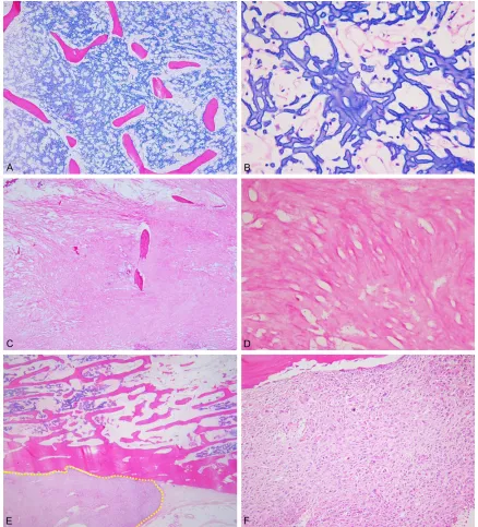 Figure 3. Typical histologic findings of necrotic and viable areas in osteosarcoma after neo-adjuvant chemotherapy