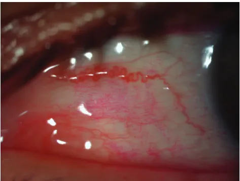 Figure 3 Typical dotted staining of the conjunctiva by rose bengal.