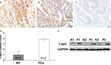 Figure 1. CapG expression was evaluated in prostate cancer. A: CapG expression was detected in high grade of prostate cancer by IHC
