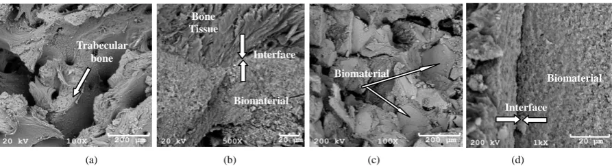 Figure 8. (a) HA/b-TCP biopsy, 60 days, trabecular bone tissue; (b) Osseointegration and interface; (c) HA/b-TCP biopsy, 90 days, osseointegration; (d) Biomaterial/bone tissue interface