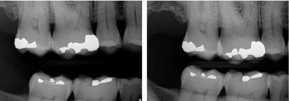 Figure 1 Bitewing Radiographs of the Right Posterior Teeth taken 3 months before pain  occurred 