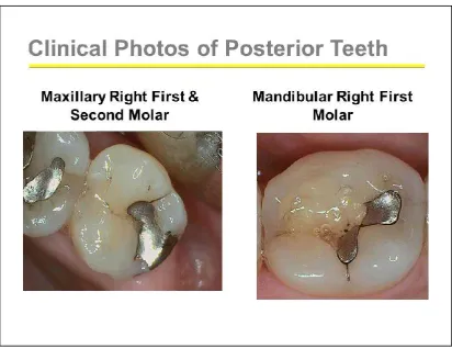 Figure 2 Occlusal view of the Mandibular Right Second Molar 