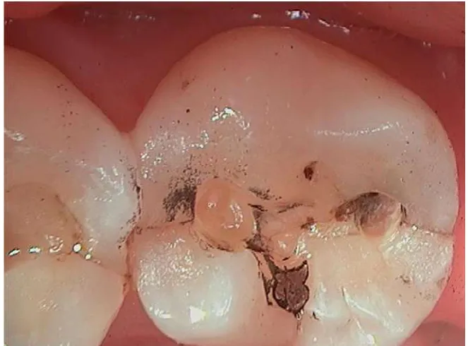 Figure 4:  Canary Scan of the Occlusal Surface of the Mandibular Right Second Molar.  The  Canary Scale indicates that there are defects in the crystal structure of the tooth in three locations requiring treatment