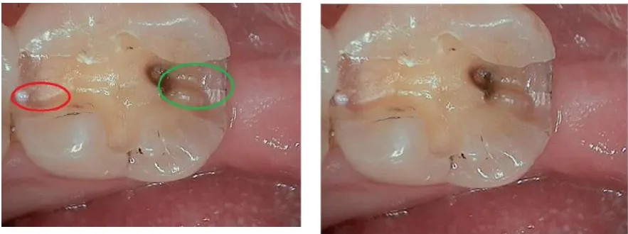 Figure 6  Image taken after removal of the amalgam and preparation of the proximal boxes
