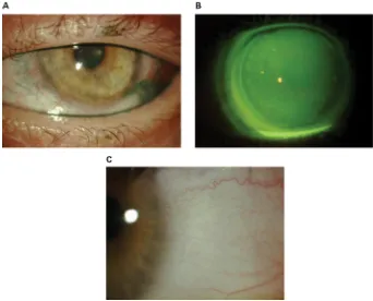 Figure 5 Patient with chronic graft-versus-host disease whose lissamine green staining improved following scleral lens therapy.Notes: (A) Lissamine green staining; (B) scleral lens fit; (C) improvement in corneal staining following 3 months of daily scleral lens wear.