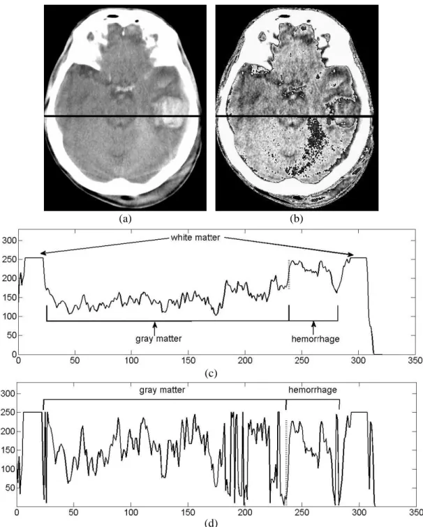 Figure 5. Image profile.  (a) Cerebral hemorrhage image.  (b) Intensity Profile. 