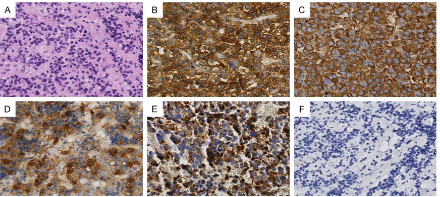 Figure 1. Immunohistochemistry of pituitary adenoma tissue. Immunohistochemical staining among the tumor cells