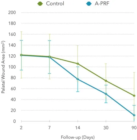 Figure 1. Surgical technique for application of advanced platelet-rich fibrin (A-PRF), and evaluation of postoperative epithelialization in the PRF and test groups at baseline, 14 days and 30 days after surgery