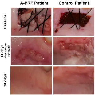 Table 1 and represented in Figure 2. On the second day sutures where intact, and in the test 