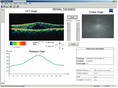 Figure 4 screenshot of OCT Line scan Os follow-up visit #1 July 25, 2005. Abbereviation: OCT, optical coherence tomography