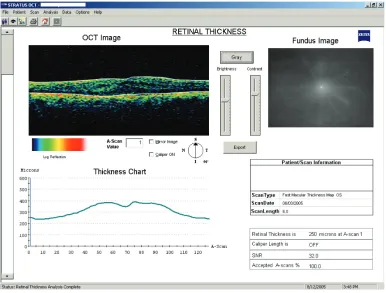 Figure 5 screenshot of OCT Line scan Os follow-up visit #2 August 3, 2005. Abbereviation: OCT, optical coherence tomography