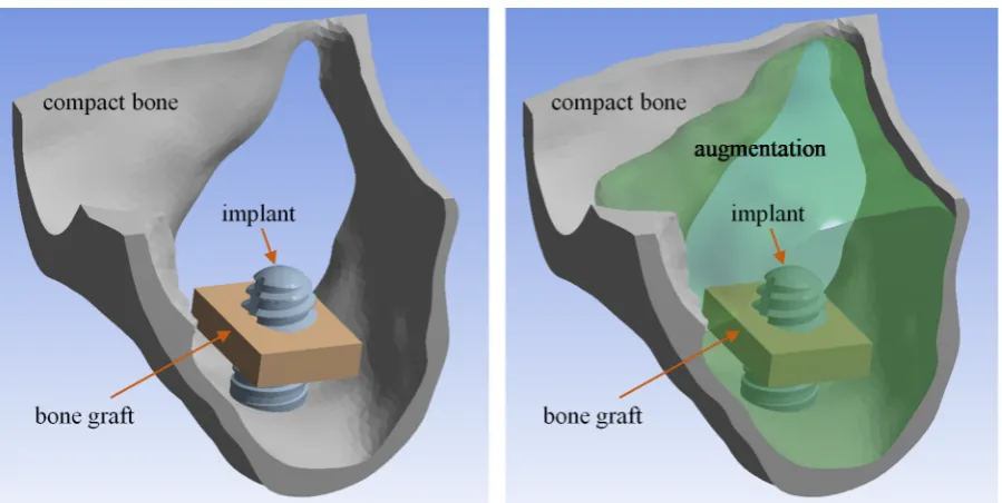 Figure 3     Figure 3. M2_c model – left: compact bone, the implant and the bone graft in middle position; right: 