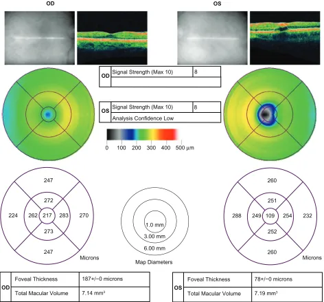 Figure 2 Optical computed topography (OCT) scans of both eyes indicate slight macular thinning OD and significant macular thinning (hole) OS at initial examination.